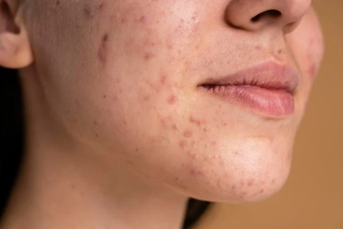 Jerawat yang Tak Kunjung Hilang? Solusi Skincare untuk Usia 30+ dengan Kulit Berjerawat (Ilustrasi)