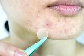 Jerawat Kecil Putih: Apakah Itu Purging?