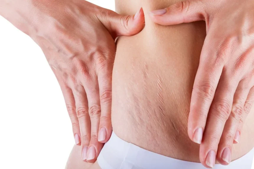 Selamat Tinggal Selulit: Kenali Krim Anti-Selulit dengan Aminofilin