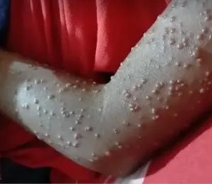 Torso Bella Virus: Bukan Virus Baru, Tapi Rubella yang Sedang Kebanjiran Perhatian