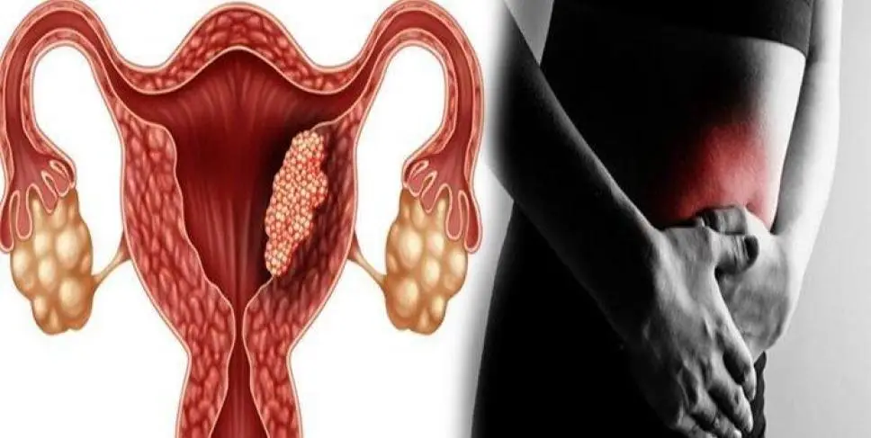 Peran Genetik dalam Risiko Kanker Ovarium pada Anak: Apa yang Perlu Diketahui Orang Tua? (Ilustrasi)