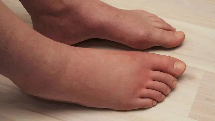 Cara Mengatasi Kaki Bengkak Secara Alami dan Cepat (Ilustrasi)