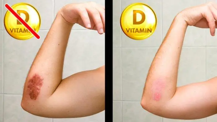 Hati-Hati! Ini Tanda Tubuhmu Kekurangan Vitamin D (Ilustrasi)