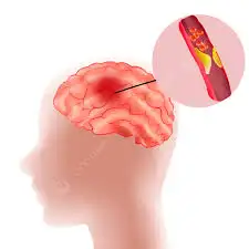 Mengenal Stroke dan Kejalanya (Ilustrasi)